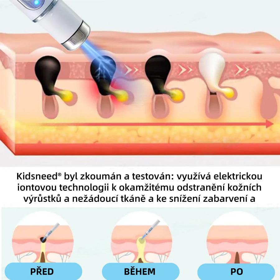 KIDSNEED® Neinvazivní laserové pero na odstranění bradavic a znamének - silně Recommended by the Czech Dermatovenerological Society (ČDS)🔥
