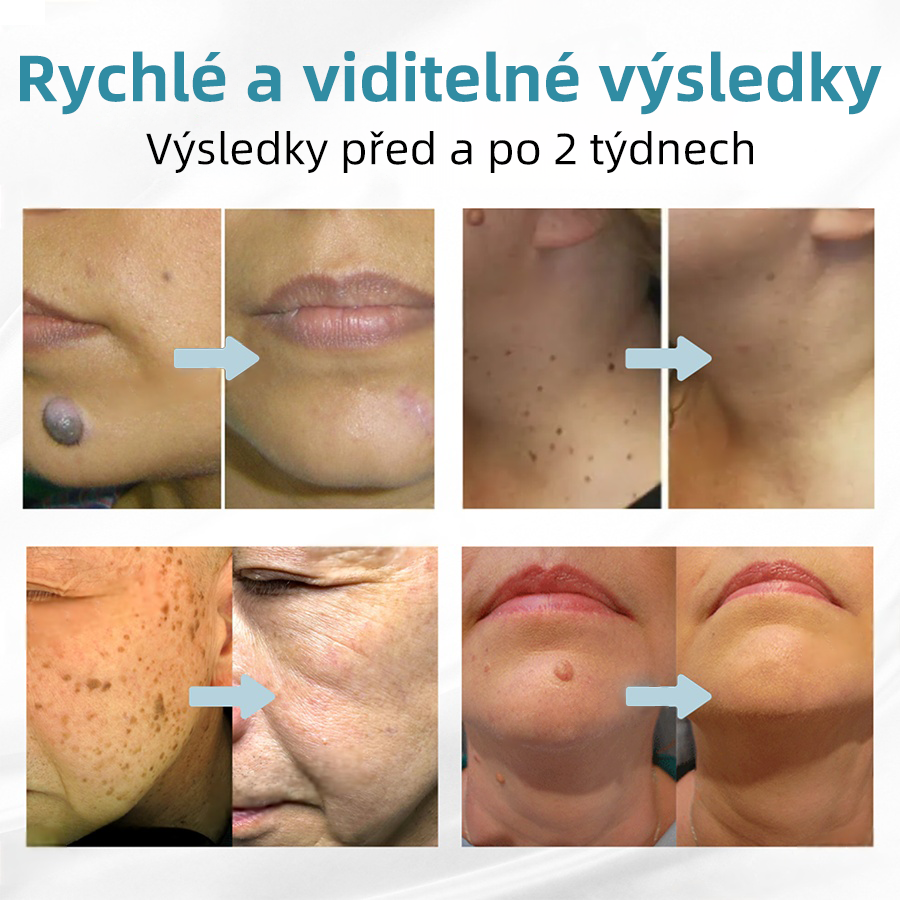 Bikenda® Neinvazivní laserový pero na odstraňování bradavic a molů Superior🔥