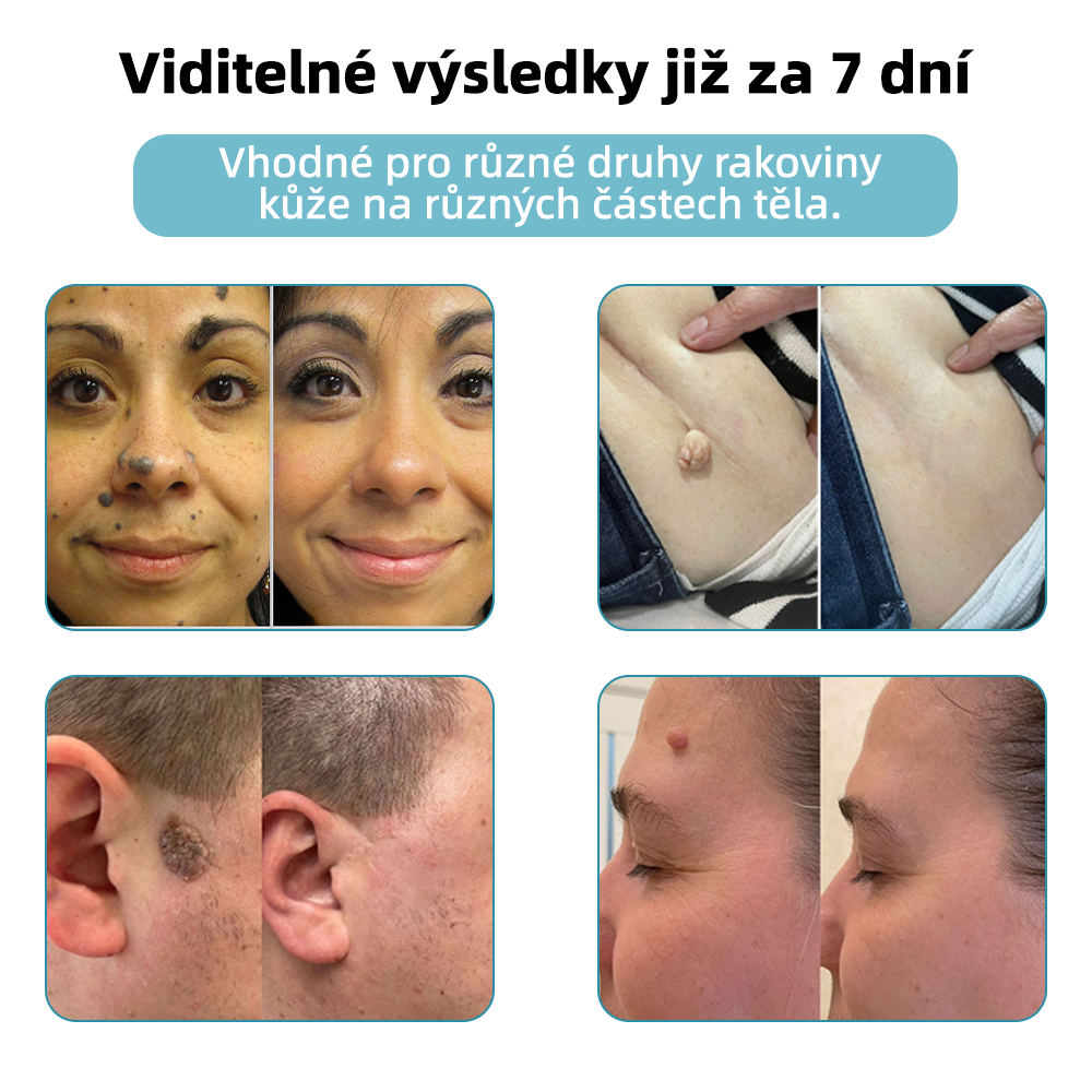 KIDSNEED® Neinvazivní laserové pero na odstranění bradavic a znamének - silně Recommended by the Czech Dermatovenerological Society (ČDS)🔥