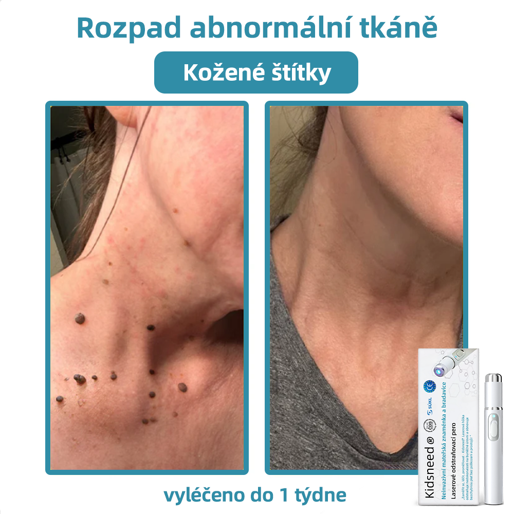 KIDSNEED® Neinvazivní laserové pero na odstranění bradavic a znamének - silně Recommended by the Czech Dermatovenerological Society (ČDS)🔥