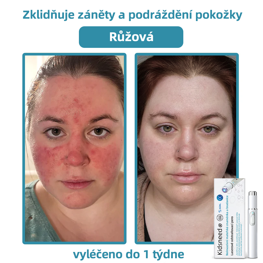 KIDSNEED® Neinvazivní laserové pero na odstranění bradavic a znamének - silně Recommended by the Czech Dermatovenerological Society (ČDS)🔥