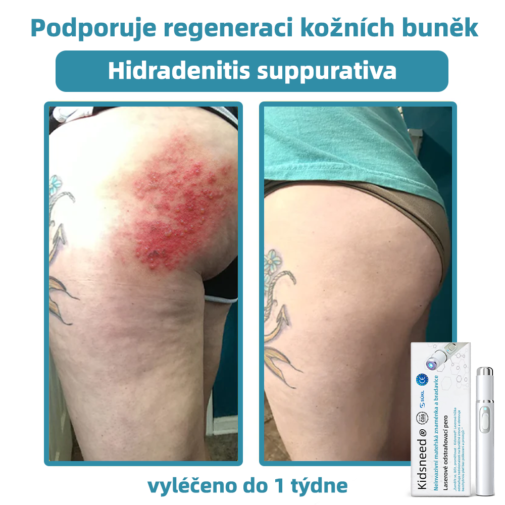 KIDSNEED® Neinvazivní laserové pero na odstranění bradavic a znamének - silně Recommended by the Czech Dermatovenerological Society (ČDS)🔥