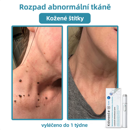 KIDSNEED® Neinvazivní laserové pero na odstranění bradavic a znamének - silně Recommended by the Czech Dermatovenerological Society (ČDS)🔥