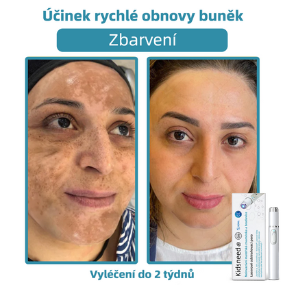 KIDSNEED® Neinvazivní laserové pero na odstranění bradavic a znamének - silně Recommended by the Czech Dermatovenerological Society (ČDS)🔥